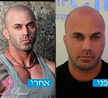 לפני ואחרי עיבוי שיער לגברים