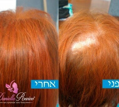 תמונות לפני ואחרי פתרונות לשיער דליל בקרב נשים